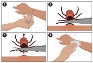 Graphic shows how to remove a tick. First step is to find tweezers. Then grasp the tick as close to the skin as possible, where the mouth is biting. Third, pull straight up (don't twist). Fourth, clean the bite site with soap and water.